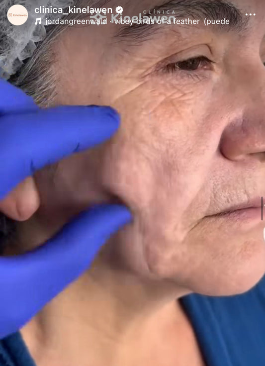 Metodo MAHD facial
